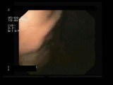 Gastric Fundal Varices • Video • MEDtube.net