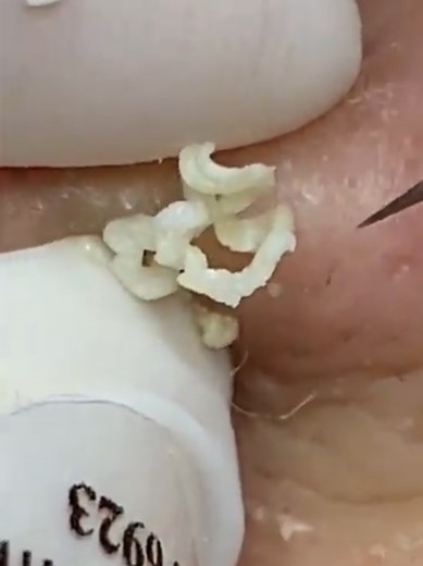 Blackhead Removal Spa Treatment: Satisfying Experience