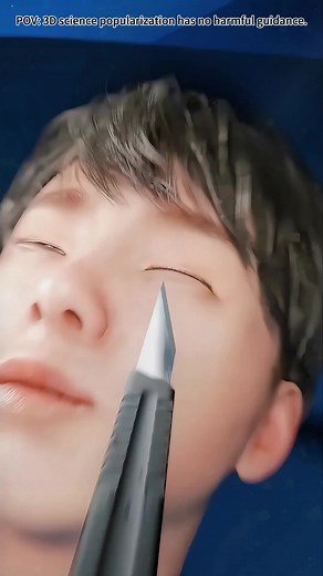 Double Eyelid Surgery Explained: 3D Animation Overview