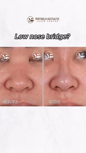 Dreaming of a lifted, more defined nose—without surgery? Meet the HIKO Nose Lift—a non-surgical treatment that instantly lifts, refines, and adds subtle height to your nose bridge using PDO threads. 💉 🎥 Watch the reel to see how this quick procedure delivers natural, balanced results with minimal downtime. ✔️ Non-surgical nose enhancement ✔️ Instant lift and definition ✔️ Walk-in, walk-out confidence 📩 DM us to book your HIKO Nose Lift today! 📩 DM us to book an appointment. - 📍2/F Tri-AX Tw