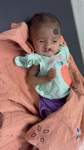 A boy having lip & cleft palate. Before & after surgery. #cleftlip #cleftpalate | Plastic Surgeon - Dr. Md. Mahbubur Rahman