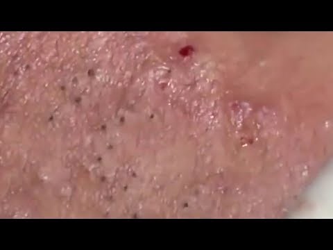 How To Remove Blackheads And Whiteheads On Face Easy #102 ✦ Dr Laelia ✦