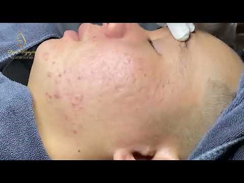 Loan Nguyen Acne Treatment #316