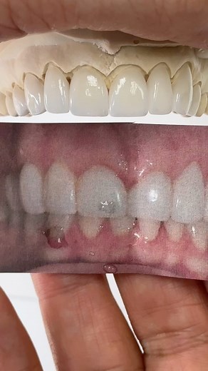 4.3K views · 17 reactions | Signature Amber Press Veneers! Case from Dr. Michelle Barrera in Illinois! | CEO Luke Kahng | Facebook