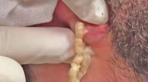 Dilated Pores, Ear Cysts & Biggest Blackhead Trivia with Jennifer! 👉 WATCH OTHER VIDEOS: 1. 𝐌𝐚𝐠𝐢𝐜 𝐬𝐮𝐫𝐠𝐞𝐫𝐲 𝐫𝐞𝐦𝐨𝐯𝐚𝐥 𝐏𝐢𝐦𝐩𝐥𝐞 𝐏𝐎𝐏 𝐨𝐧 𝐀𝐫𝐦𝐩𝐢𝐭 𝐁𝐎𝐈𝐋 𝐏𝐔𝐒 𝐘𝐨𝐮𝐓𝐮𝐛𝐞 @ https://fb.com/415981465902263 2. Blackheads Removal, Popping, Squeezing, Extracting #28 @ https://fb.com/471581920248617 3. Huge cyst is being popped. Prepare yourself! @ https://fb.com/356810641608910 4. Pimple Popper Tools! Why Should We Use Them? @ https://fb.com/640765736387239 5. blackhea