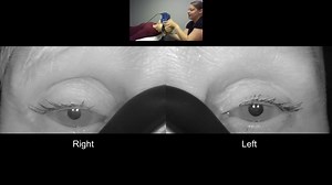 55K views · 109 reactions | ⬇️ Do you see the downbeat nystagmus?...