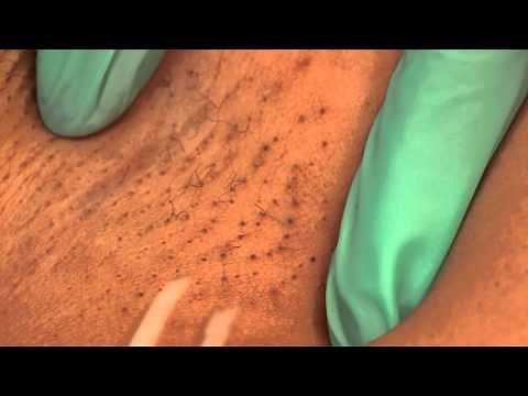 Tweezing the Underarms : Waxing & Tweezing