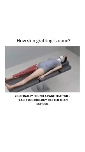BIOLOGY | HEALTH | MEDICAL | Skin grafting is a surgical procedure that transfers healthy skin from one part of the body to a damaged area, often due to burns,... | Instagram