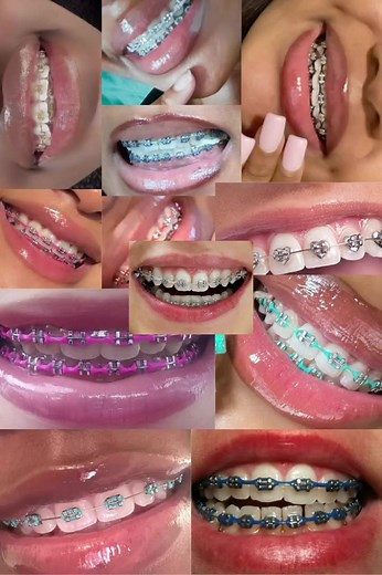 Sky Blue Rubber Brace Color Ideas for Braces