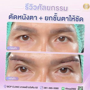 รีวิว ศัลยกรรม Subbrow Lift✨ แก้ปัญหา‼️หนังตาตก หย่อนคล้อย❤️ รอยเย็บแผลละเอียดมากๆ แผลเป็นแทบไม่มี ✅เก็บแผลใต้คิ้ว ✅หลังทำเข้าที่สามารถสักทับรอยแผลได้ค่ะ •• สอบถามเพิ่มเติมได้ที่•• 💬Line ID : @bcp2562 (มี @ ด้วยนะคะ ห้ามลืม) ☎️ Tel.061-565-5580 ______________________________________________ สามารถดูรีวิวเพิ่มเติมได้ที่กลุ่ม 👇เข้ากลุ่มกดตรงนี้เลยจร้า👇 https://www.facebook.com/groups/274257019861085/?ref=share ______________________________________________ #BCPCLINIC #subbrowlift #ตัดหนังตา #ลู