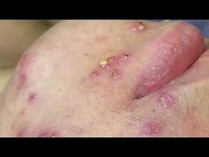 Pimple Popping ASMR | Oddly Satisfying Extractions