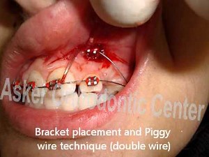 Orthodontic traction of impacted maxillary cuspid by Dr.Amr Asker