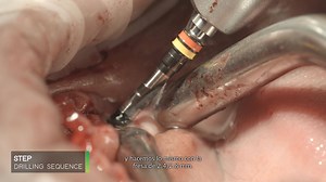 4.8K views · 55 reactions | Watch the NeO sensation drilling...