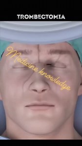 1.7K views · 18 reactions | #What_is_a_thrombectomy? A thrombectomy is a surgery to remove a blood clot from a blood vessel (artery or vein). A blood clot, also known as a thrombus, can interrupt the blood flow to your extremities and/or organs that can be limb or life-threatening. Some of the most common places for blood clots to occur are your legs, arms, intestines, brain, lungs and heart. #viralreels #medicineknowledge #reelsfacebook #shortstory @topfans | Medicine knowledge | Facebook