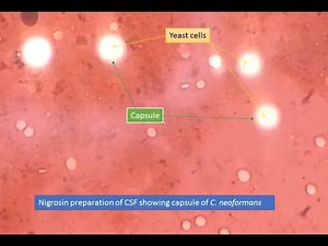 Cryptococcus capsules in Nigrosin preparation