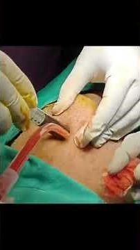 Drainage of Submental abscess