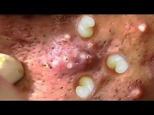 Satisfying remove blackhead Acne treatment & Blackheads popping 2021