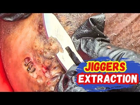 😱 extreme jigger infestation __step by step foot care guide