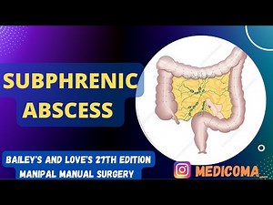 SUBPHRENIC ABSCESS || ETIOLOGY, PATHOPHYSIOLOGY, CLINICAL FEATURES,INVESTIGATION ,MANAGEMENT
