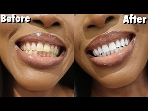 😮 How To: Teeth Whitening At Home NO Hydrogen Peroxide