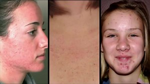 Learn how SilkPeel can help you treat acne, fine lines and wrinkles, Melasma, Rosacea, and hyperpigmentation. Save $25 on your SilkPeel through September as part of our introductory pricing offer. Call us at (801) 785-8884 to schedule your SilkPeel. | Aesthetica | Facebook