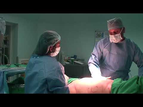 Basics of Liposuction Step by step tutorial of Cosmetic surgery procedures