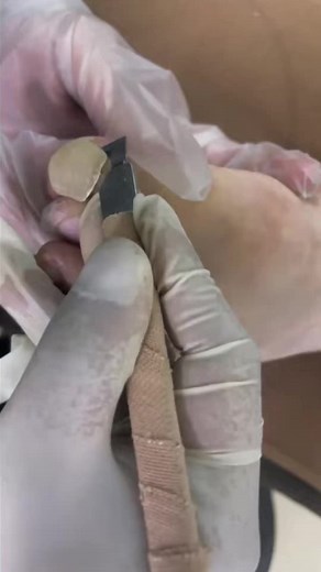 4.9K views · 15 reactions | toenailroomb Big Toenail Removal & Pedicure Treatment #reels | Atlas Professional Risk Management | Facebook