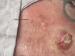 Dr Pimple Popper pops huge cyst which oozes pus everywhere