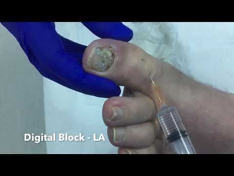 Digital Toe Block - Ingrown Toe Nail