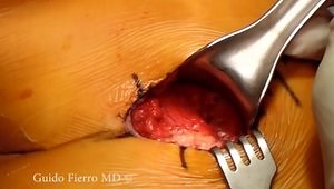 Quadrilateral Space Decompression Surgery