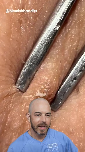 Cyst Squeezing Video - Watch the Removal Process