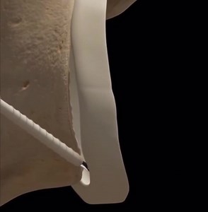 Bankart Repair. A Bankart lesion is a shoulder injury that occurs due to a labrum tear causing instability and recurrent dislocations of the shoulder joint. Arthroscopic Bankart repair is a minimally invasive surgical procedure performed to reattach and tighten the detached labrum within the shoulder joint. #bankartrepair #shouldersurgery #shoulderpain #shoulderdislocation #shoulderinstability #gleniodlabruminjury #shouldersurgeryrecovery #shouldersurgeon #osteopathy #physicaltherapy #physiother