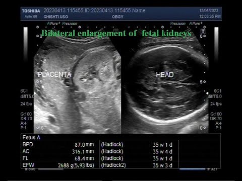 Bilateral enlargement of fetal kidneys with Pregnancy of about 35 weeks.