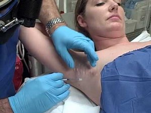 Axillary Armpit Botox for Excess Sweating Hyperhidrosis