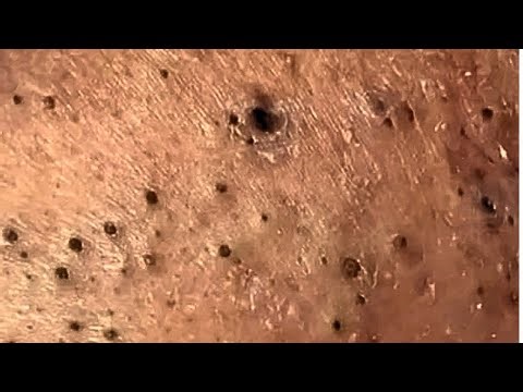 Ultimate Blackhead ASMR Compilation for Relaxation 07 #satisfying #asmr