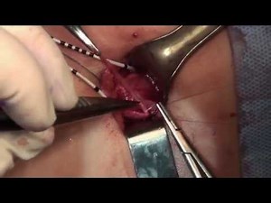 Dismembered Reductive Pyeloplasty - Dr. Pippi Salle