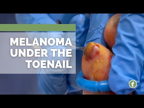 Melanoma UNDER the toenail?!