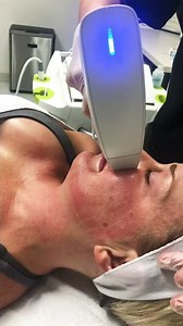 Venus Viva RF for facial skin resurfacing