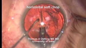 1.6K views · 41 reactions | Soft lens nucleofractis is surprisingly...