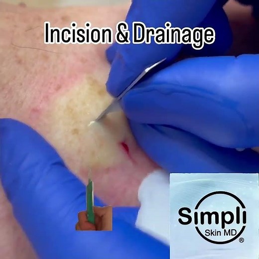 Abscess/Boil Incision & Drainage