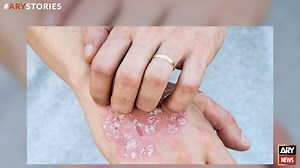 Dr. Sri Kumar Goturu initiates a group to create awareness about psoriasis as it is on a rise. #ARYNews | ARY News