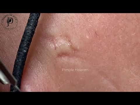 Brutal Blackhead Removal Around Mouth — Satisfying Close Up