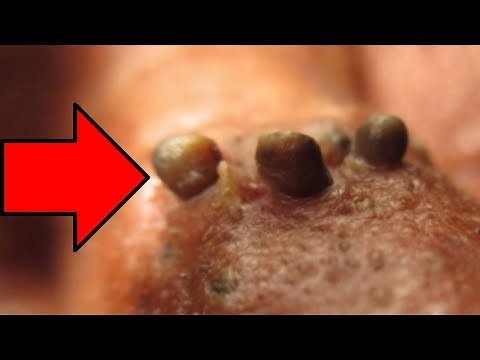 Nose Blackheads, Chin Blackheads & Pimple Pops