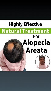 2.2K views | Alopecia areata natural treatments #alopecia #alopeciaareata #alopeciacure #hairloss #hairfall #alopeciatreatmentcenter #alopeciatotalis #alopeciatreatmentcenter #alopeciatotalis | Alopecia Cure | Facebook