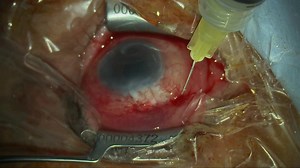 Unedited video of needling | Glaucoma Guru