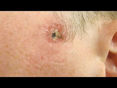 Carcinome basocellulaire