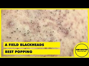 Suri Job 53: A BEST BLACKHEADS FIELD