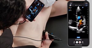 Point of care ultrasound at the bedside in Cardiology | Butterfly iQ3