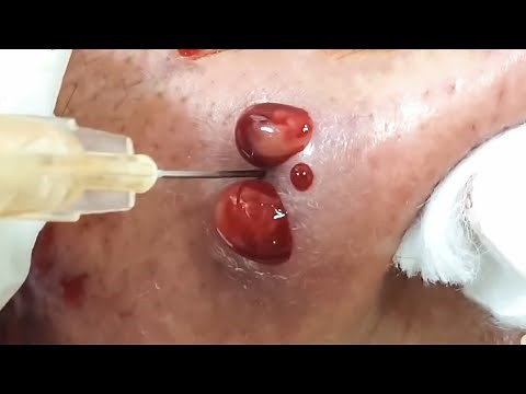Best Pimples Popping Blackheads ||