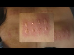 What to expect when you go get tested for allergies